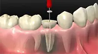 Tratamiento de endodoncia